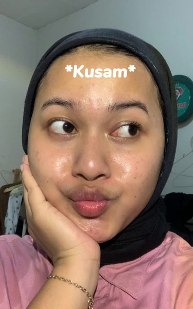 Iklan skincare TikTok kusam bekas jerawat warna kulit tidak merata