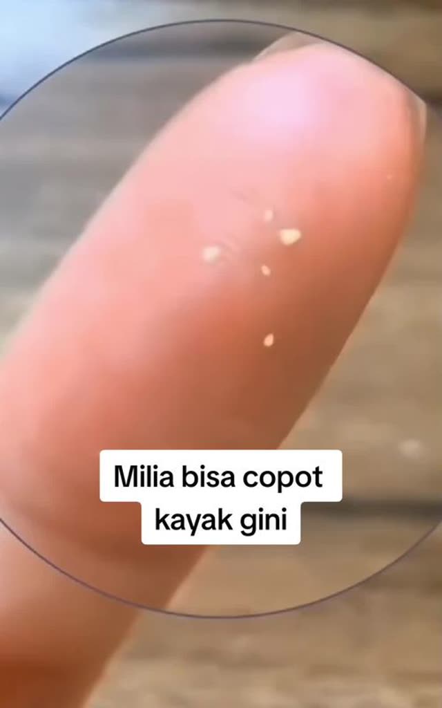 Iklan skincare TikTok milia bisa copot